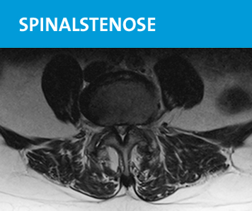 wzfr-orthopaede-wirbelsaeulenspezialist-roggendorf-spinalstenose